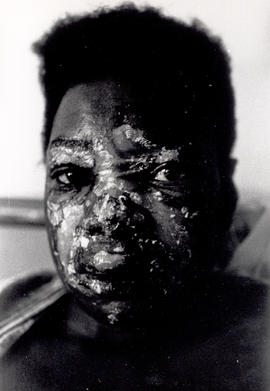 Portius Blassius - his face seriously burnt during interrogation by the South African troops in N...