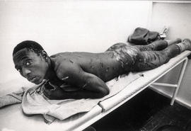 Black youth with heavy scars on his back, buttocks and legs after beating by vigilantes in Thabon...