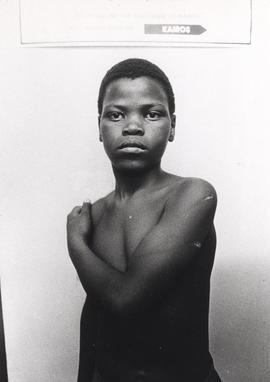 Young boy William Nyathela with traces of abuse on his body after his release from detention, in ...